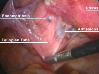 https://www.elpartoesnuestro.es/sites/default/files/2011/04/endometriosis_and_adhesion_1.jpg